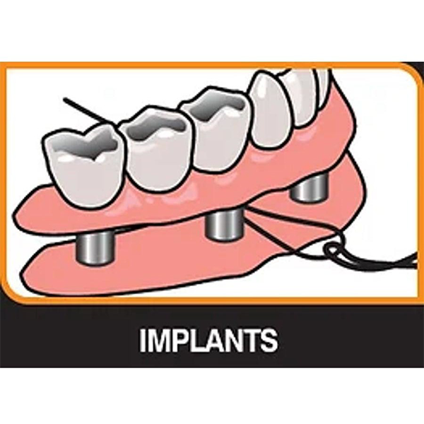 iDontix X-Threaders- Dental Floss Threaders - 30 Threaders - 1 Packet
